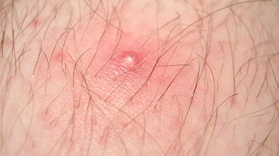 Photo of Ingrown Hair on someone's arm